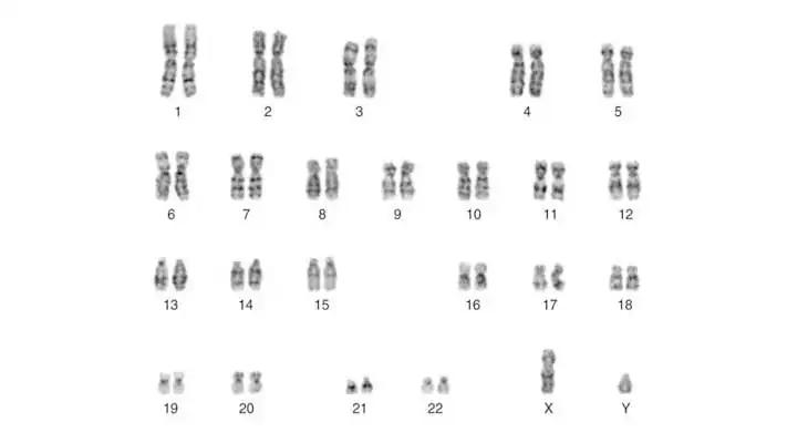 染色体异常胎停怎么治疗,胎停三次夫妻染色体正常