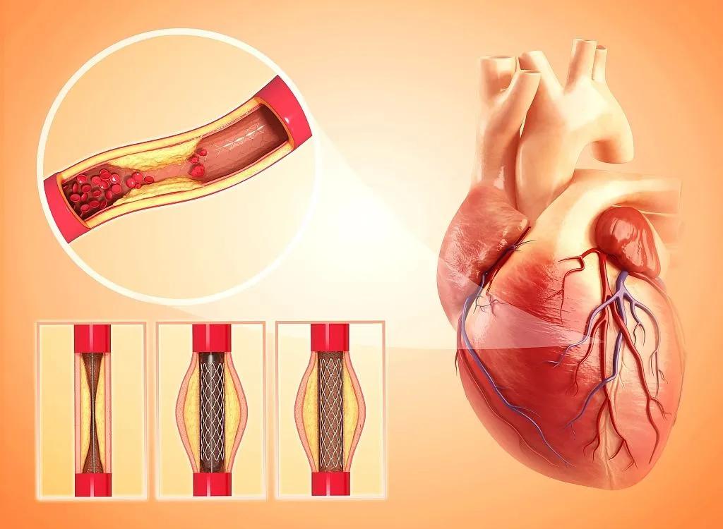 阿司匹林能溶血栓吗,溶血栓阿司匹林