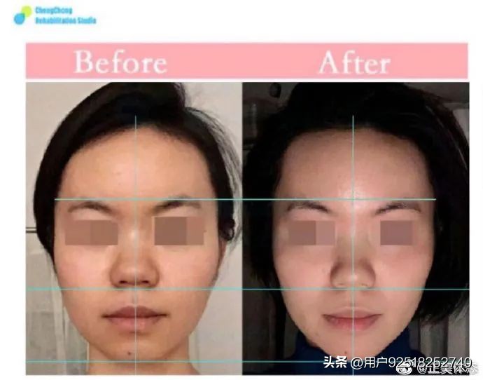 法令纹鼻基底深怎么改善,怎么判断法令纹是鼻基底凹陷