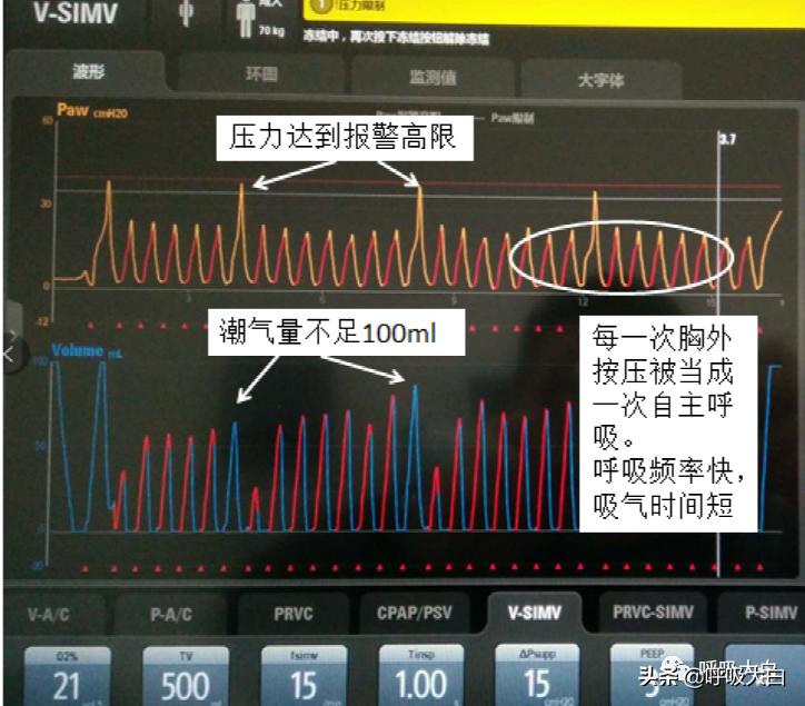 呼吸机：报警设置、心脏按压时的呼吸机设置