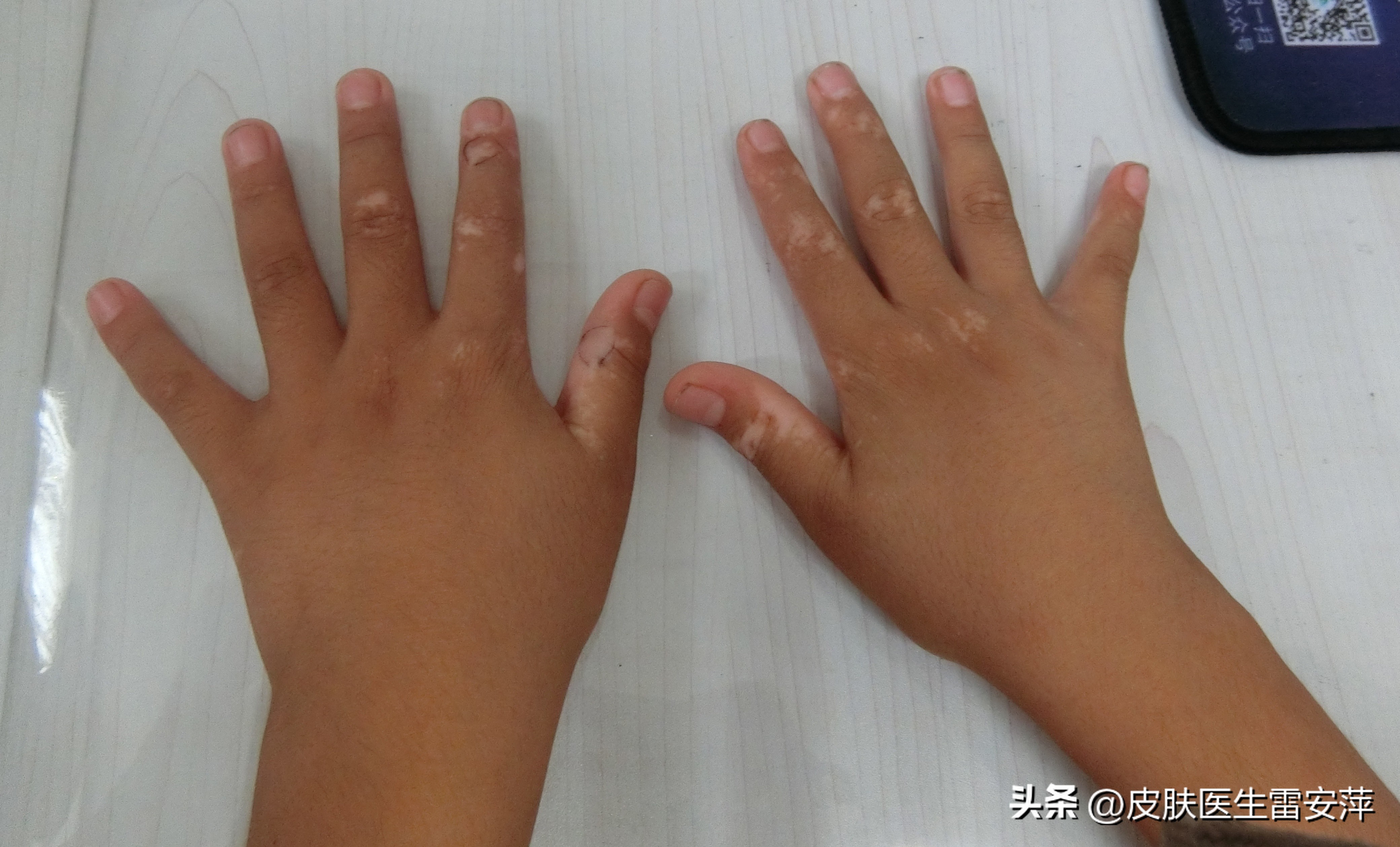 皮肤白癜风怎么遮盖,白癜风手上的白斑是不是最难治疗