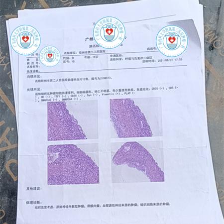 肺部肿瘤长在憩室里面,肺部5厘米的肿瘤要长多久