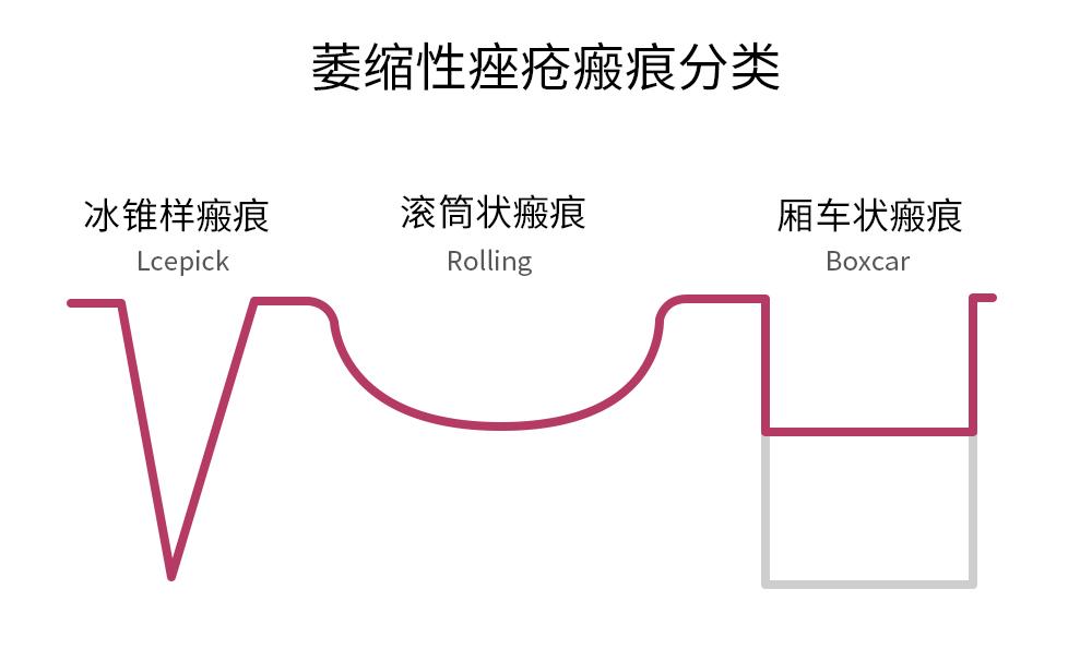 痘坑剥离激光点阵后长痘痘,痘坑点阵激光能彻底去除吗