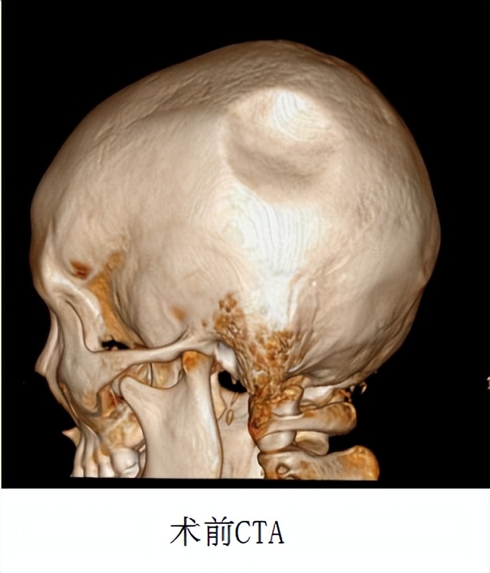 飞来横祸，初中生脑袋被铅球砸出一个“坑”