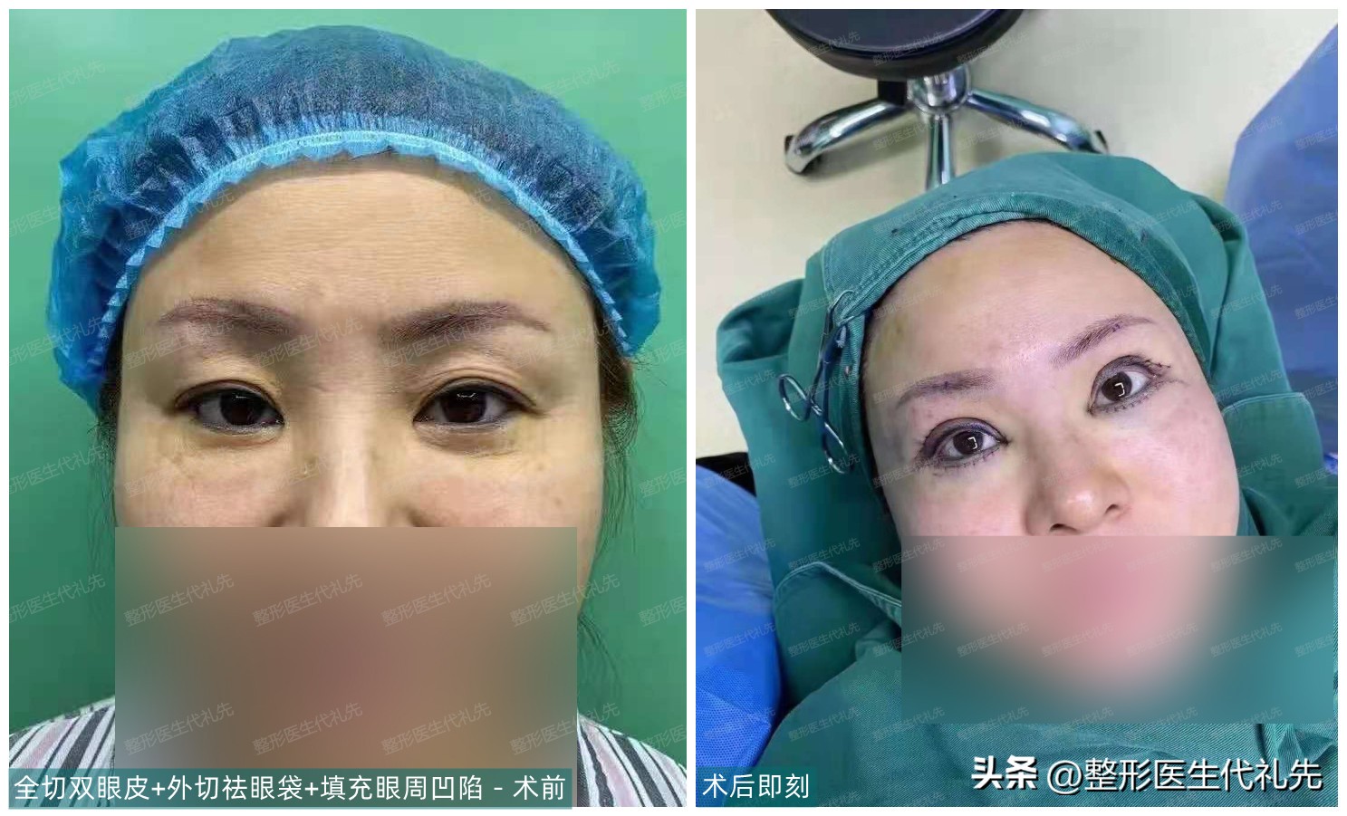 眼袋失败修复真实案例,眼袋手术失败怎样去做鉴定