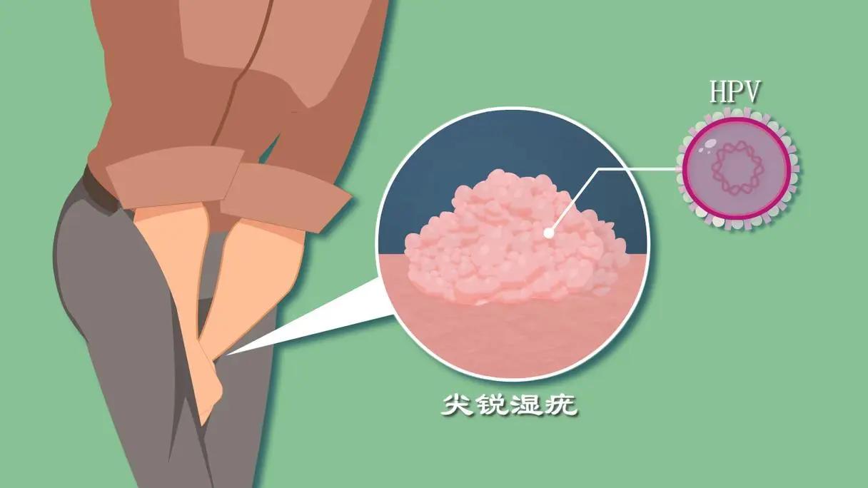 每个人身上都有疣,身上四种疣