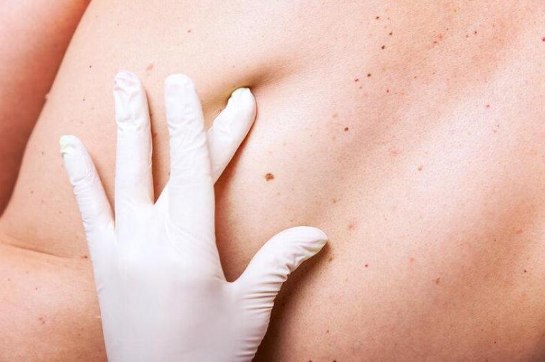 警惕这些痣可能会成瘤,哪些地方有痣代表得癌症了