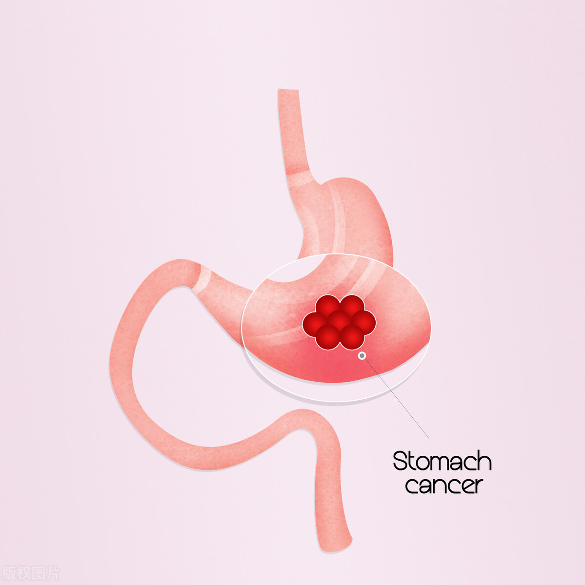 无痛胃镜检查前的准备和注意事项,无痛胃镜摘除息肉后饮食注意哪些