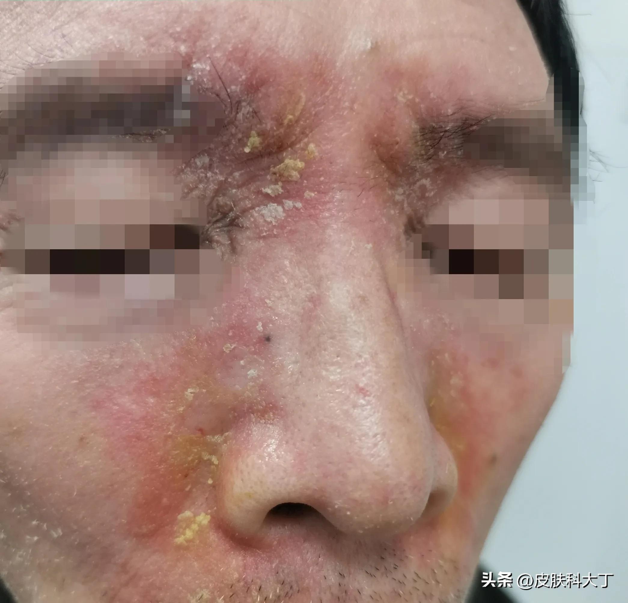 脸上又油又干还痒中医,脸上又油又痒