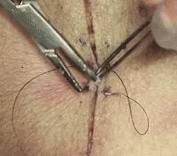 外科各种缝合方法的适用情况,外科操作缝合