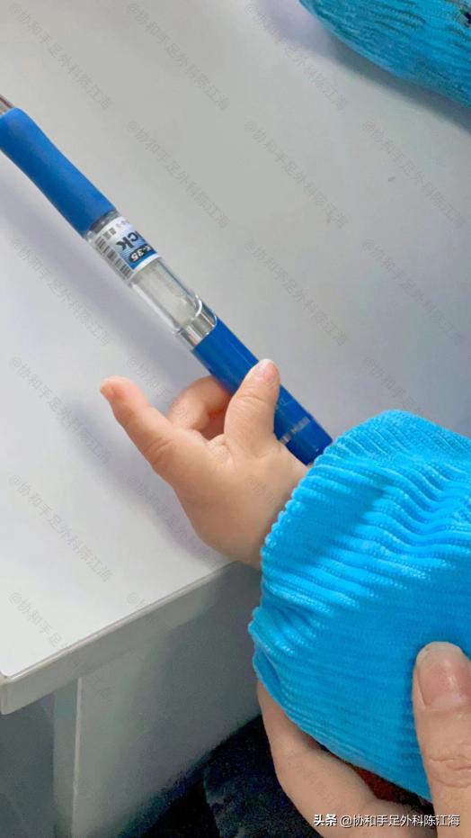 儿童天生手指并指畸形能治好吗,孩子拇指畸形