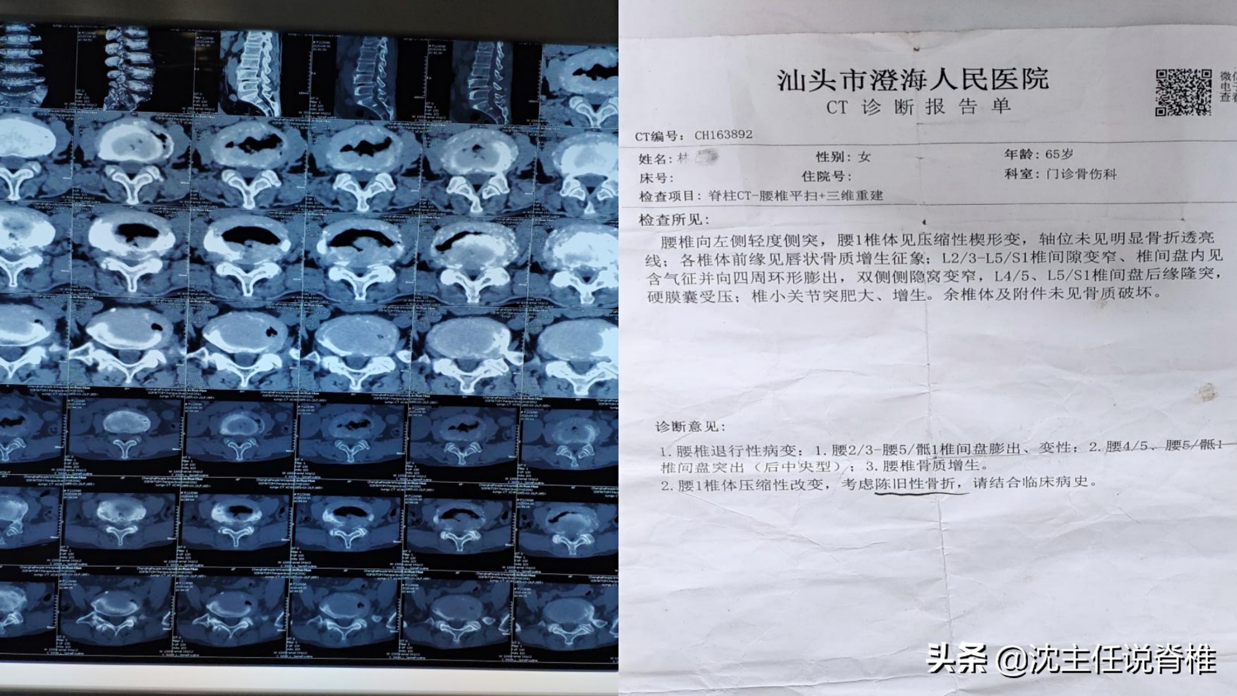老人摔倒股骨颈骨折最佳治疗方案,老年偏瘫侧股骨颈骨折怎么办