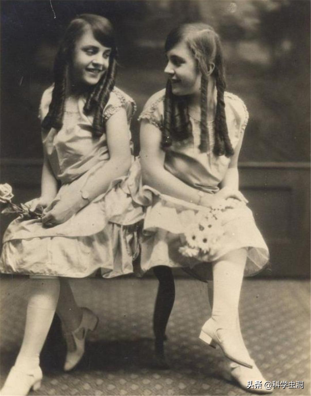 连体姐妹其中一个人死了怎么办,连体姐妹一个死了另一个咋办