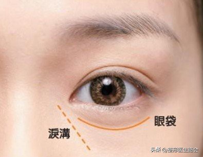 40岁泪沟用什么填充最好,40岁眼袋泪沟最好的解决方法