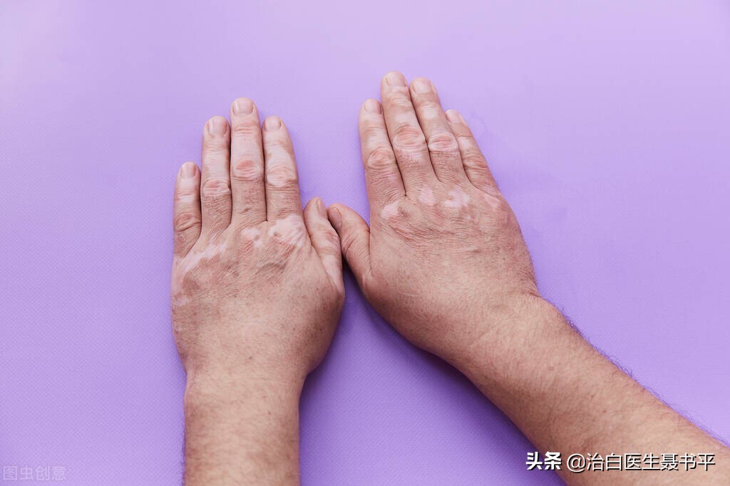 晚期白癜风自愈的最佳方法,白癜风要怎么治疗才可以控制病情