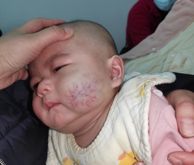 孩子身上有不明显的红点怎么回事,小孩子身上有红疙瘩疑似血管瘤