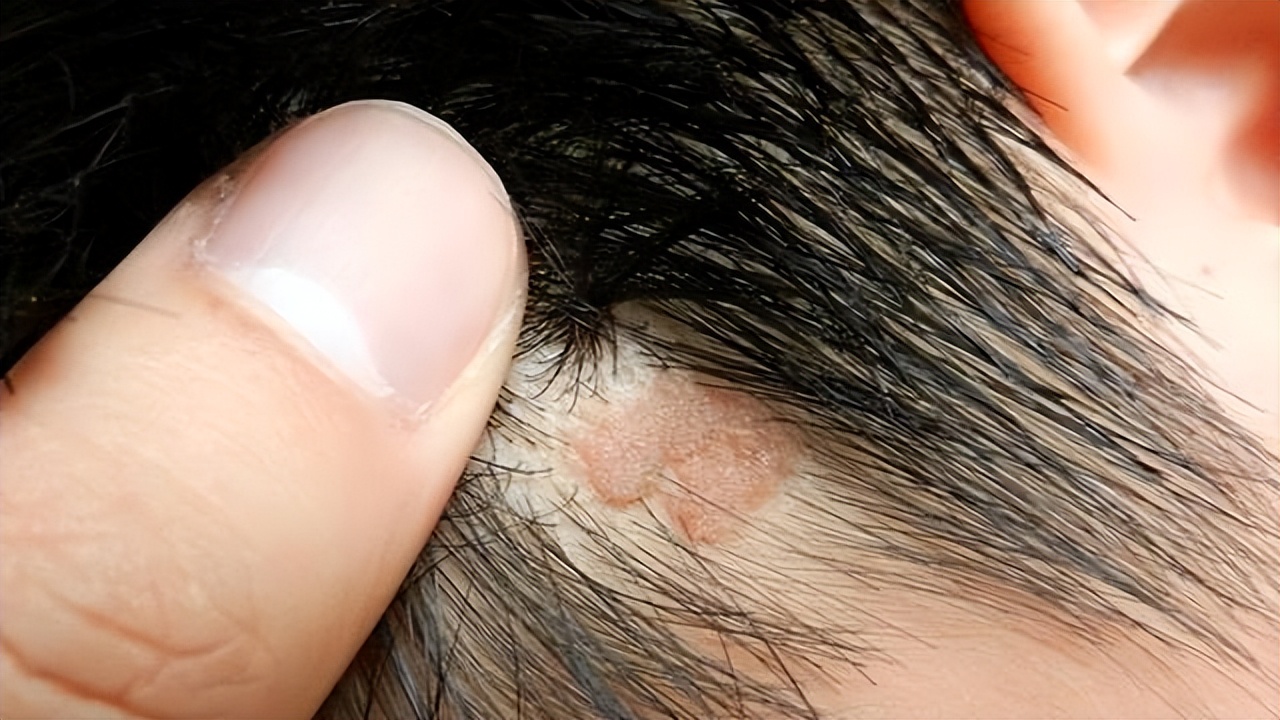 头皮里长的脓包疙瘩是什么原因,头皮上总是长疙瘩和脓包如何根治