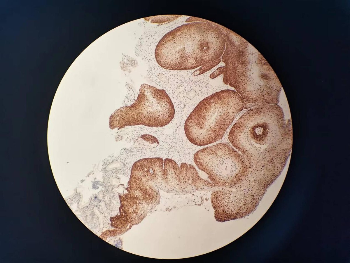 HPV感染和宫颈癌的预防与早期发现