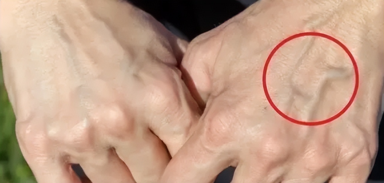 胳膊青筋手背青筋多是怎么回事,人体青筋明显是什么问题