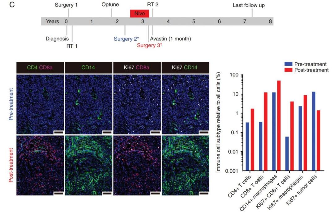 纳武单抗治疗肺癌效果,纳武利尤单抗治疗胃癌转移骨癌