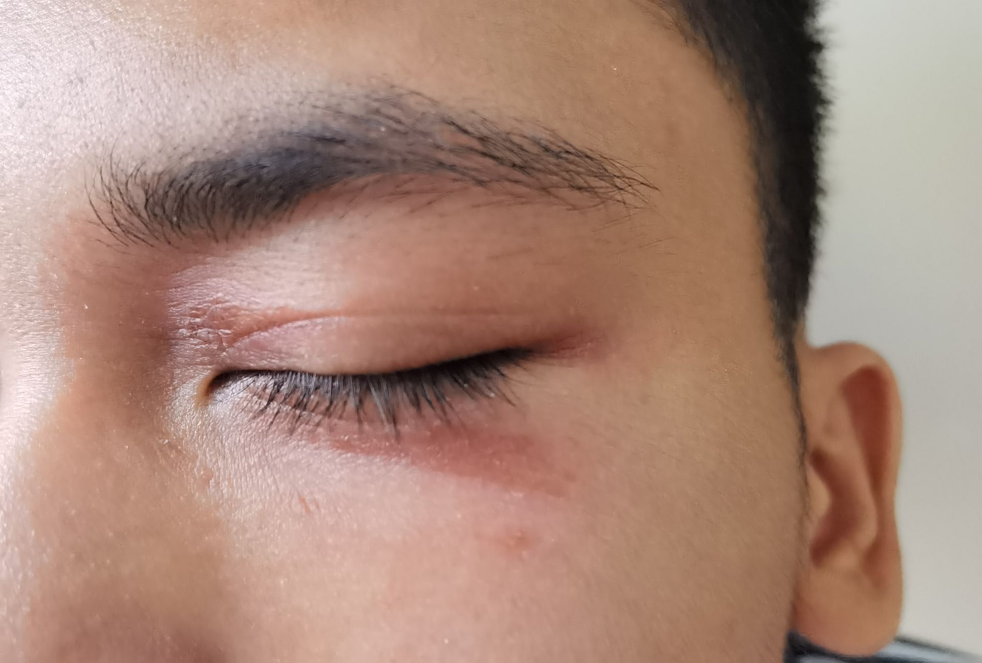 隐翅虫室内防范措施,当心隐翅虫