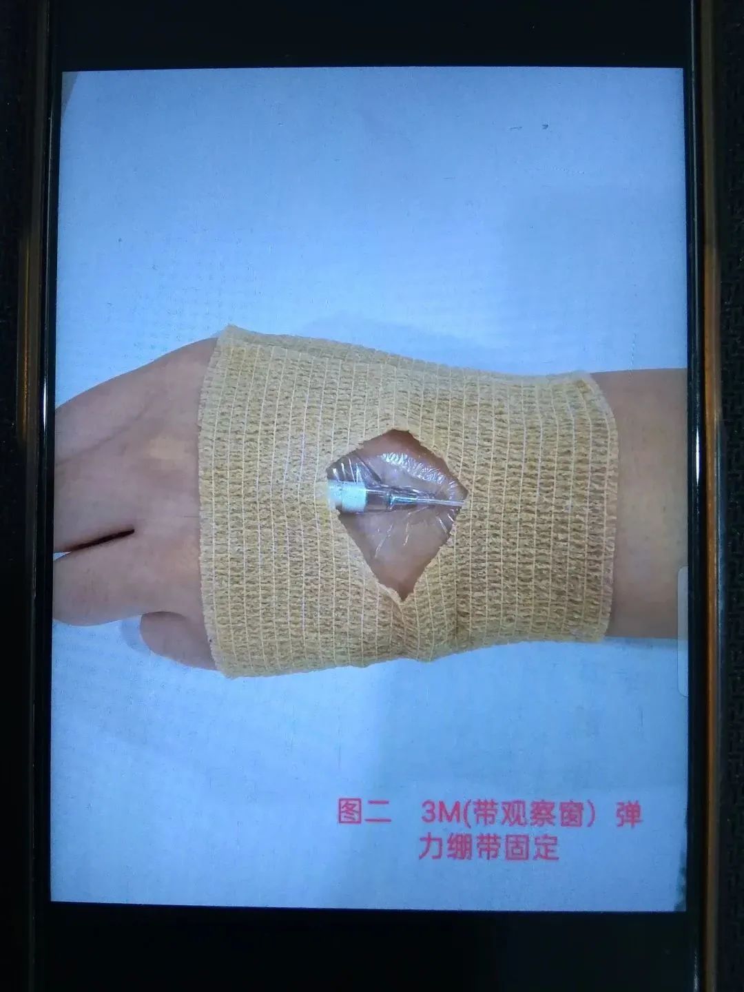 婴幼儿留置针固定最好的方法,如何能快速固定新生儿留置针