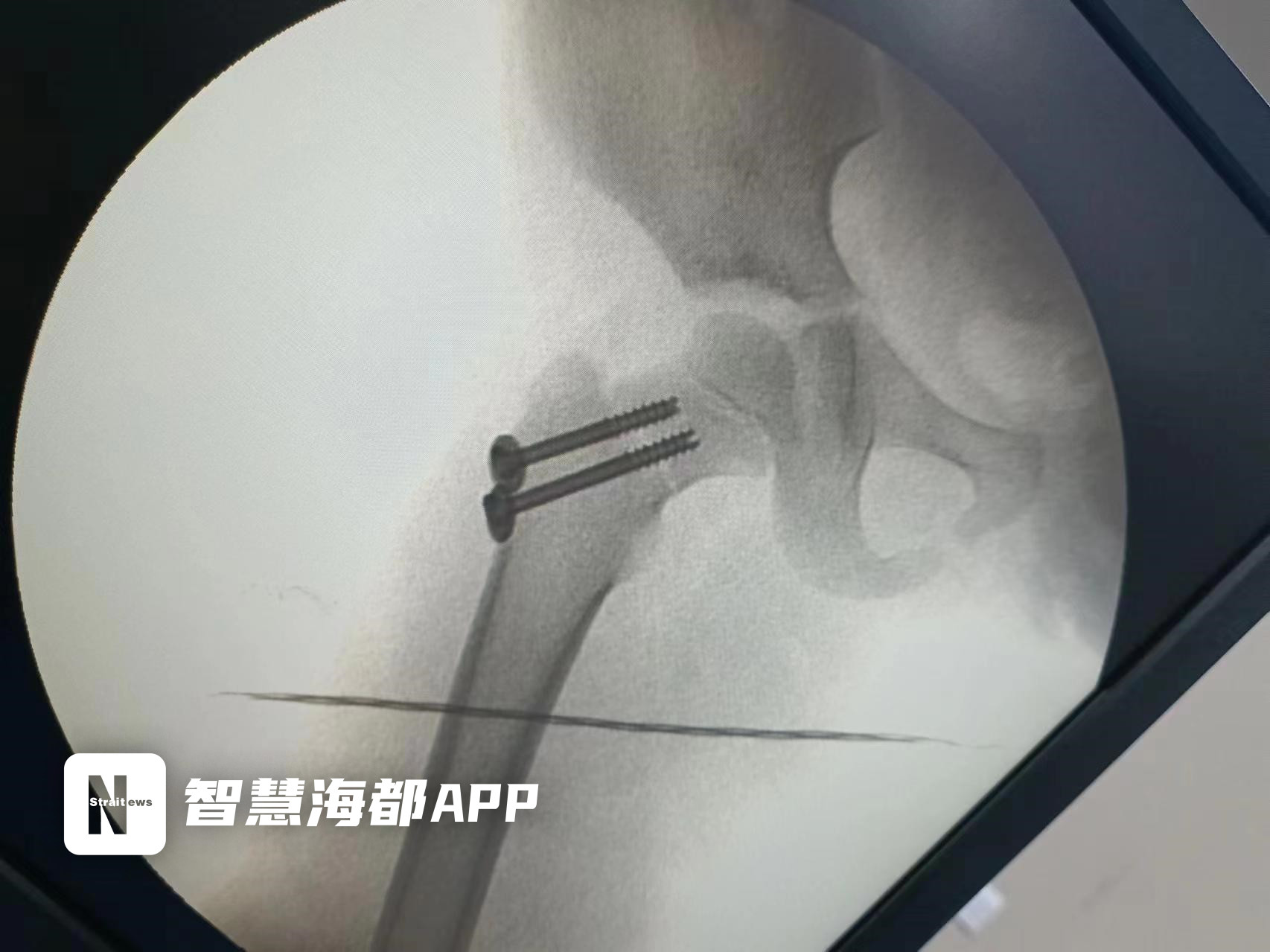 泉州儿童医院扶梯摔倒,泉州一女童从四楼掉下