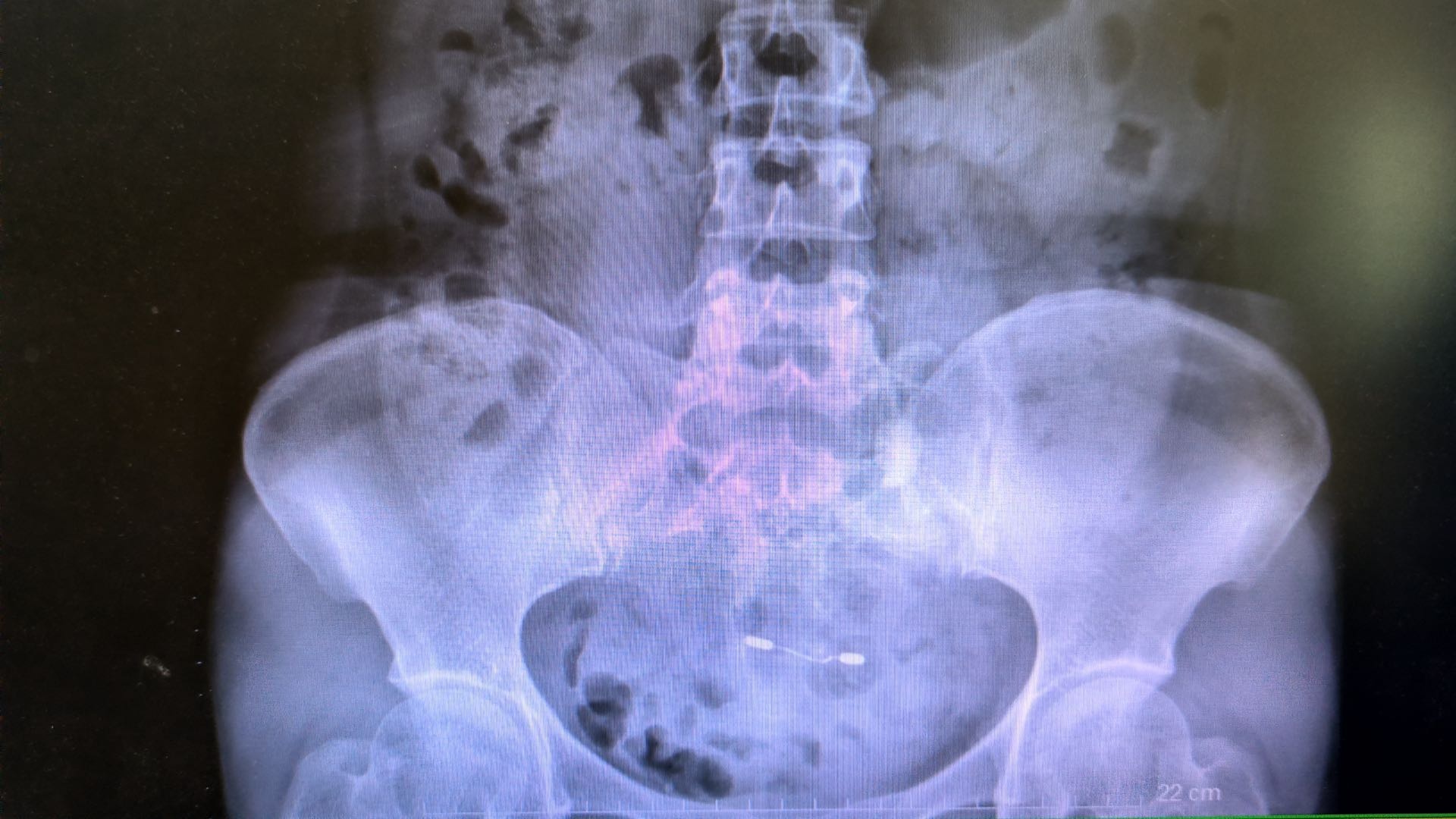 碎石清石治疗输尿管结石,碎石后快速排结石