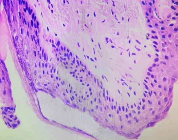 耳内长肿瘤良性与恶性的症状区别,耳内长肿瘤