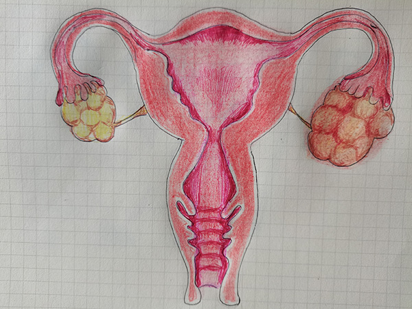 卵巢肿瘤肚子疼,卵巢肿瘤腹痛的症状