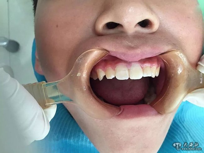 小虎的牙齿坏了,小虎牙齿被炸掉了