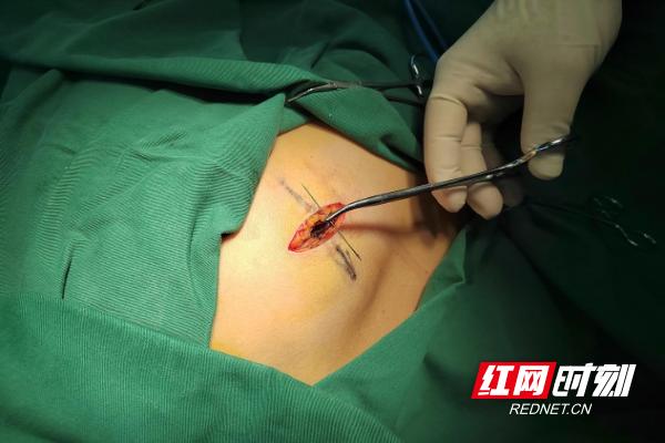 株洲市三三一医院：绣花针为何扎入背部小孙子竟是“刺客”