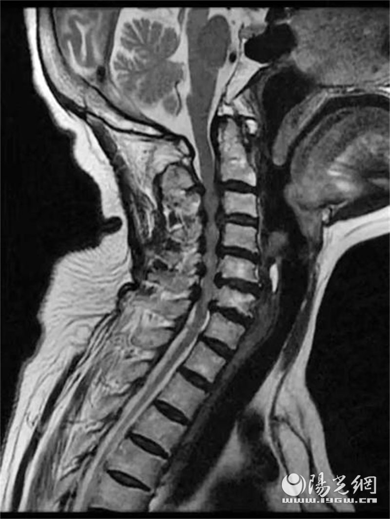 颈椎侧攻螺钉内固定图片,颈椎后路螺钉固定手术是微创吗