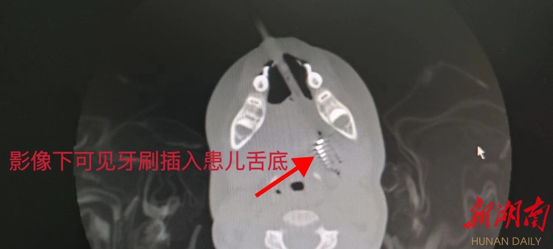 牙刷卡在喉咙里小妙招,科普异物卡喉成人互救急救方法