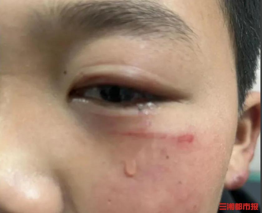 孩子被同学用铅笔戳伤眼皮怎么办,小孩被钢筋割伤了怎么处理