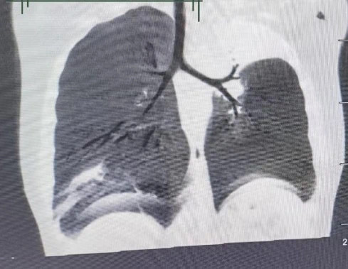 5岁宝宝一发烧都是肺炎咋回事,5岁小孩咳嗽一周开始发烧