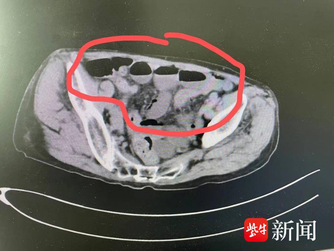 肠子罕见病,肠子掉到大腿根部