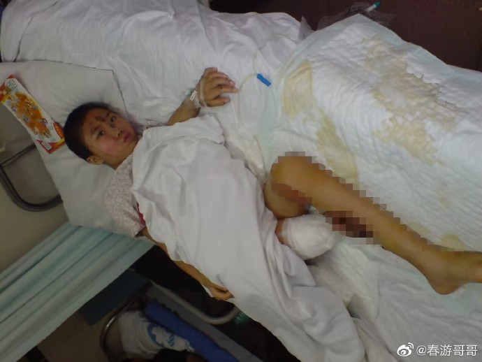 汶川地震后一个钢腿女孩的15年,汶川地震中失去双腿的女孩现状