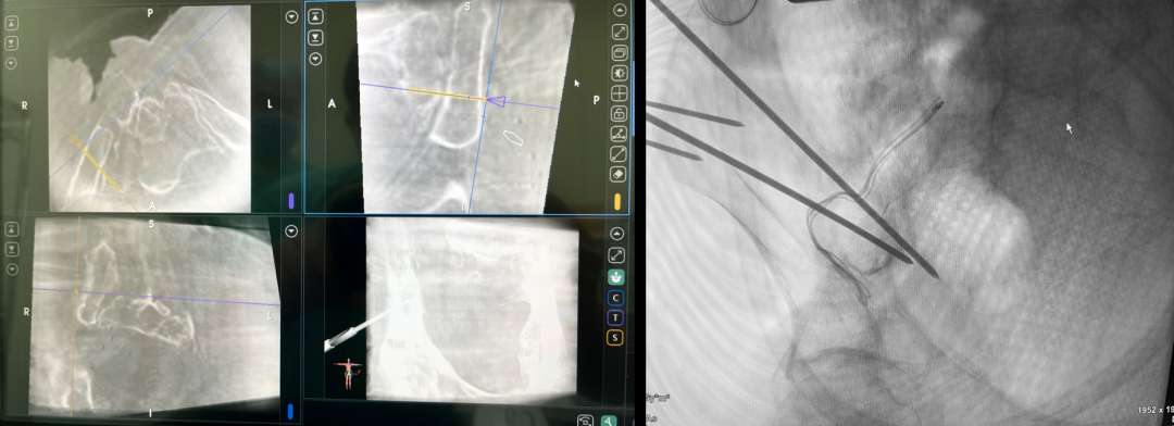 北京积水潭医院全球机器人首例,北京积水潭医院机器人工程中心