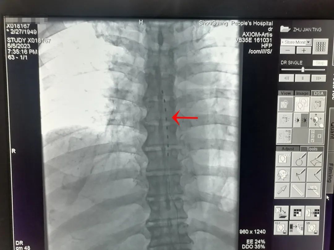 最新技术治疗中枢神经,中枢靶控镇痛术
