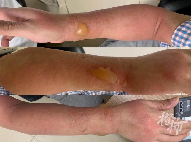 被蚊子叮后肿了一大个包,被蚊子叮了手指头整个肿了