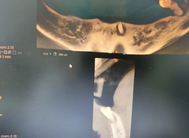 下巴有一个洞可以挤出脓,下巴上挤出黄色颗粒留下一个洞